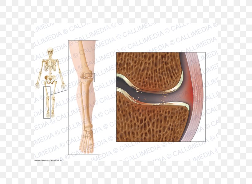 La Gonarthrose Knee Osteoarthritis Shoulder, PNG, 600x600px, Osteoarthritis, Joint, Knee, Knee Osteoarthritis, Le Havre Download Free