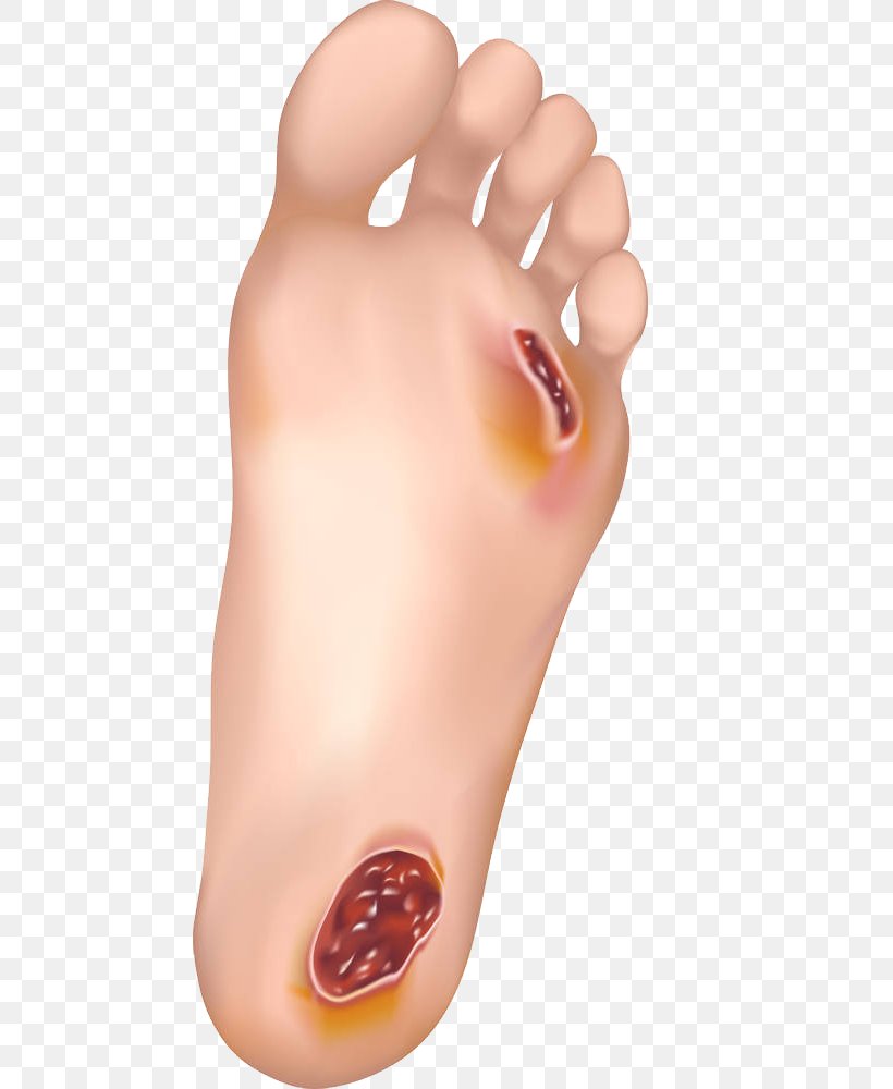 Diabetic Foot Ulcer Wound Healing Skin Ulcer, PNG, 610x1000px, Watercolor, Cartoon, Flower, Frame, Heart Download Free