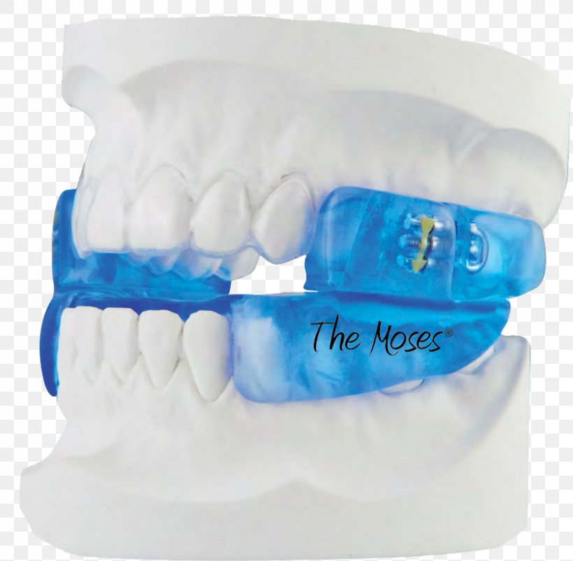 Mandibular Advancement Splint Obstructive Sleep Apnea Dentist, PNG, 840x822px, Mandibular Advancement Splint, Apnea, Dentist, Dentistry, Human Mouth Download Free