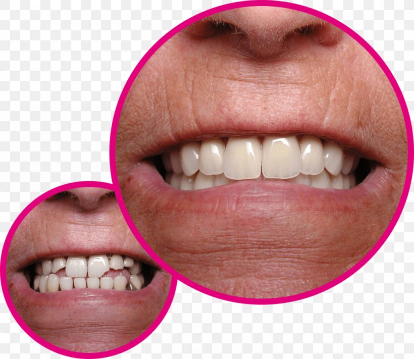 Veneer Human Tooth Gums Crown, PNG, 1024x888px, Veneer, Cheek, Chewing, Chin, Close Up Download Free
