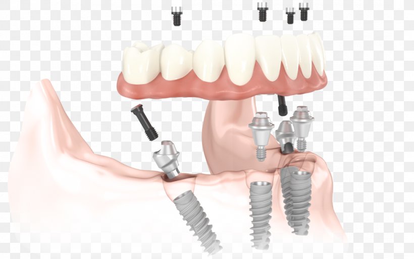 All-on-4 Dental Implant Dentistry Dentures, PNG, 1080x675px, Dental Implant, Bridge, Dental Surgery, Dentist, Dentistry Download Free