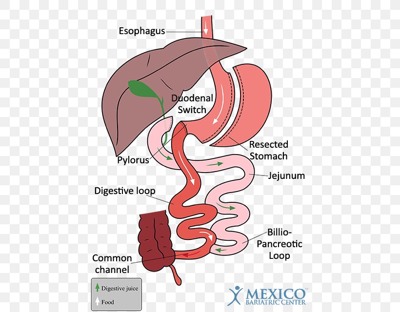 Duodenal Switch Gastric Bypass Surgery Bariatric Surgery Sleeve Gastrectomy Duodenum, PNG, 450x640px, Watercolor, Cartoon, Flower, Frame, Heart Download Free