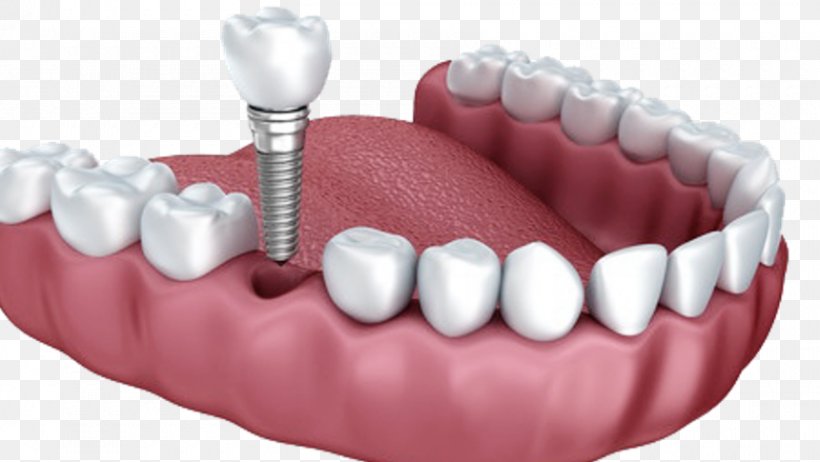 Dental Implant Dentistry Dentures, PNG, 860x485px, Dental Implant, Clinica, Cosmetic Dentistry, Dentist, Dentistry Download Free