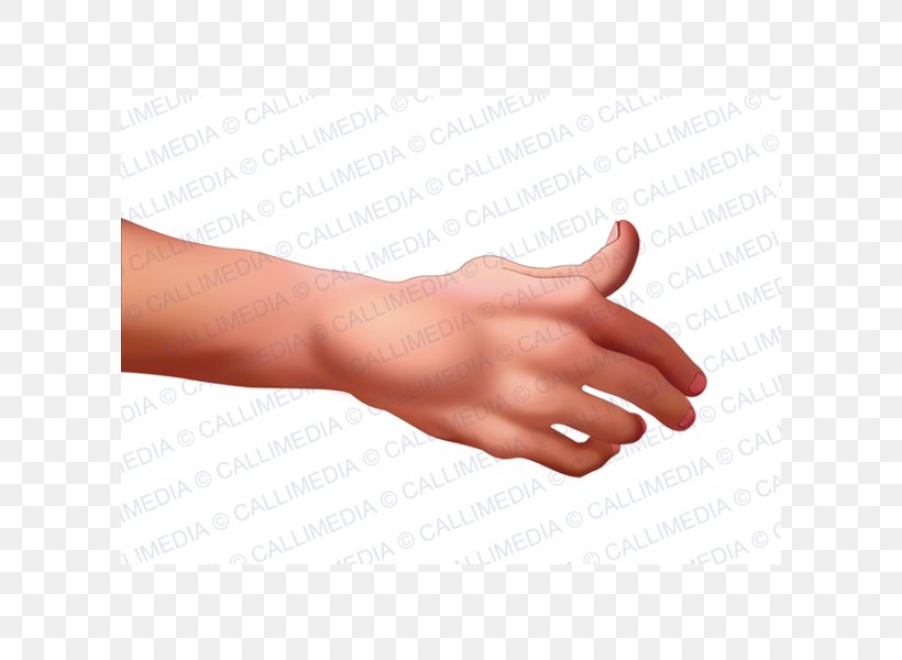 Thumb Rheumatoid Arthritis La Artritis Rheumatism, PNG, 600x600px, Thumb, Arm, Arthritis, Collagen Disease, Disease Download Free