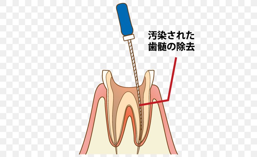 Tooth Dentist 歯科 Endodontic Therapy Root Canal, PNG, 500x500px, Watercolor, Cartoon, Flower, Frame, Heart Download Free