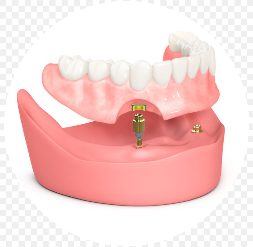 Tooth Dental Implant Dentistry Dentures Prosthesis, PNG, 800x800px, Tooth, Cosmetic Dentistry, Dental Implant, Dentist, Dentistry Download Free