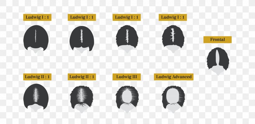 Pattern Hair Loss Hair Transplantation Hair Follicle, PNG, 2600x1264px, Pattern Hair Loss, Female, Hair, Hair Follicle, Hair Loss Download Free