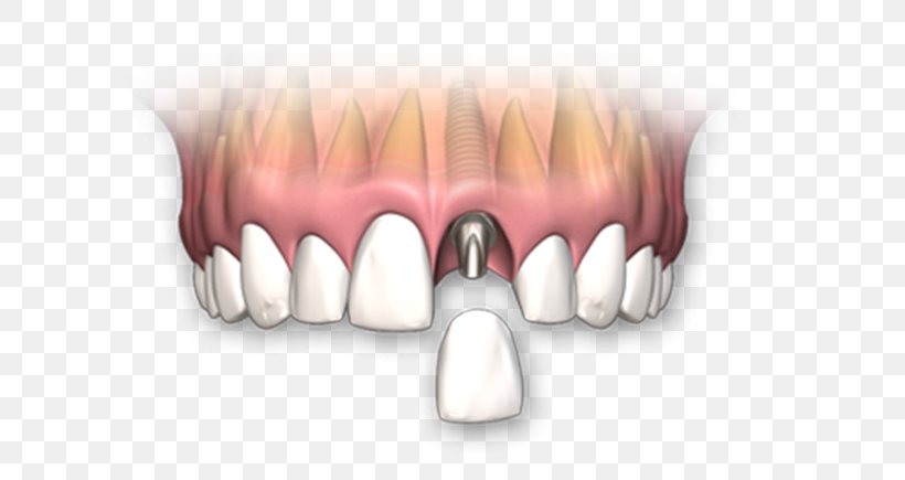 Dental Implant Dentures Dentistry Crown Human Tooth, PNG, 600x435px, Watercolor, Cartoon, Flower, Frame, Heart Download Free