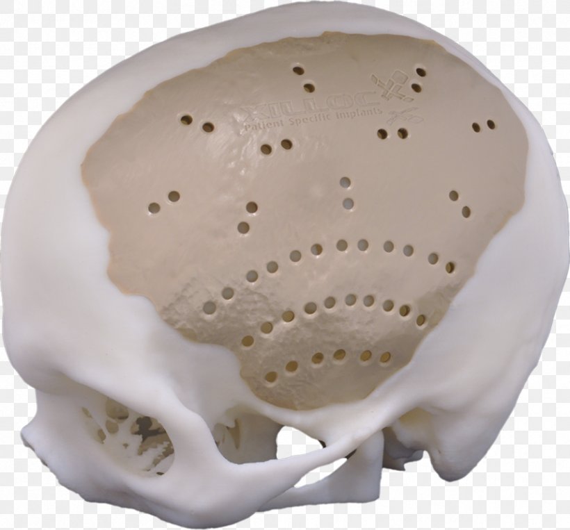 Implant Cranioplasty Polyether Ether Ketone Neurosurgery Craniotomy, PNG, 858x799px, 3d Printing, Implant, Biomaterial, Brain Haemorrhage, Cranioplasty Download Free