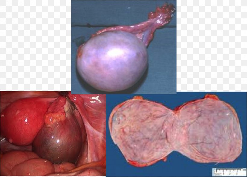 Ovarian Serous Cystadenoma Shallot, PNG, 914x656px, Shallot Download Free