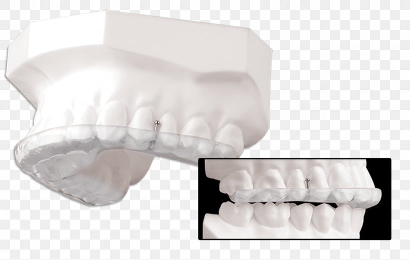 Splint Tooth Temporomandibular Joint Dysfunction Therapy Image, PNG, 950x604px, Splint, Canine Tooth, Jaw, Maxilla, Neuromuscular Disease Download Free