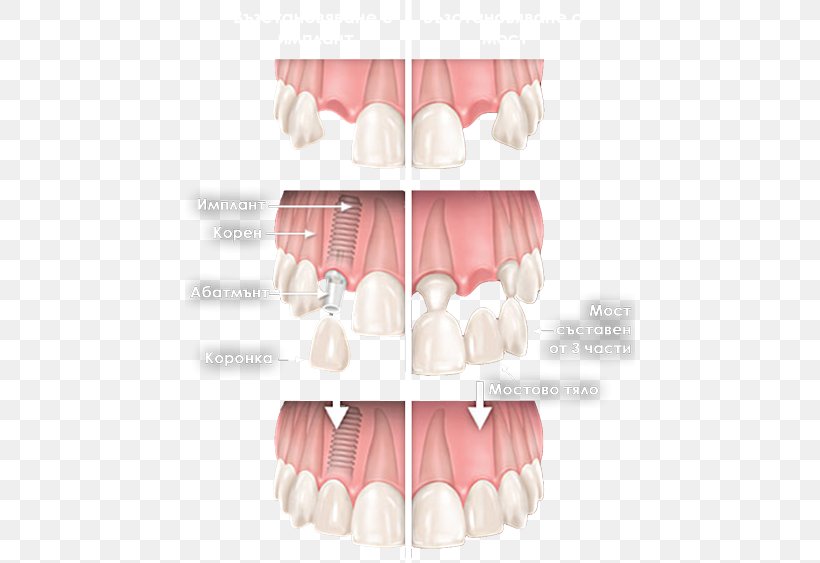Tooth Cosmetic Dentistry Dental Implant Bruxism, PNG, 450x563px, Watercolor, Cartoon, Flower, Frame, Heart Download Free