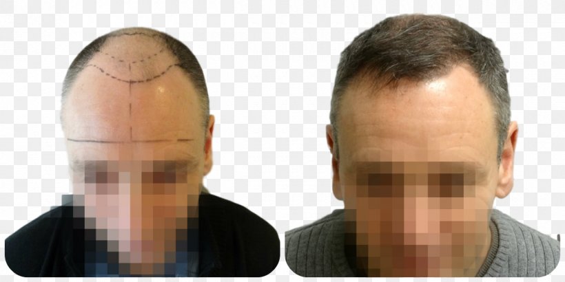 Hair Transplantation Follicular Unit Extraction Forehead Eyebrow, PNG, 1200x600px, Hair Transplantation, Cheek, Chin, Ear, Eyebrow Download Free