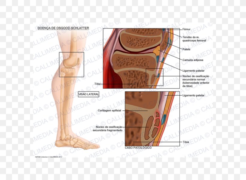 Osgood–Schlatter Disease Tuberosity Of The Tibia Growing Pains Therapy, PNG, 600x600px, Watercolor, Cartoon, Flower, Frame, Heart Download Free