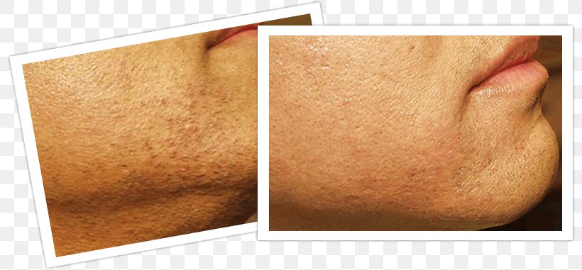 Laser Hair Removal Skin, PNG, 800x381px, Hair Removal, Chin, Com, Embarrassment, Forehead Download Free