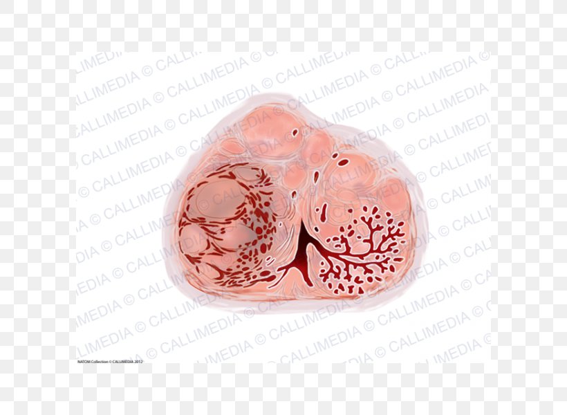 Benign Prostatic Hyperplasia Prostate Cancer Hypertrophy Transurethral Resection Of The Prostate, PNG, 600x600px, Benign Prostatic Hyperplasia, Anatomy, Benign Tumor, Fashion Accessory, Gemstone Download Free
