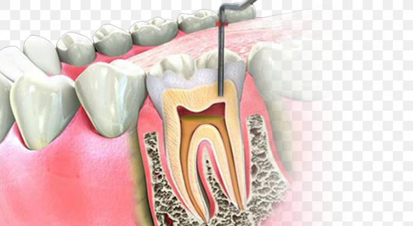Endodontic Therapy Root Canal Endodontics Dentistry, PNG, 914x501px, Watercolor, Cartoon, Flower, Frame, Heart Download Free