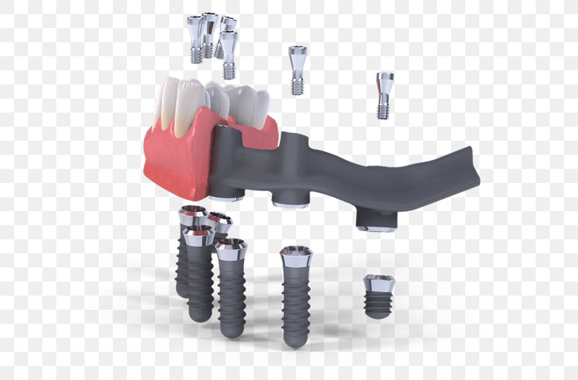 Dental Implant Straumann Dentistry Edentulism, PNG, 720x540px, Dental Implant, Bone, Bone Grafting, Dental Extraction, Dentistry Download Free