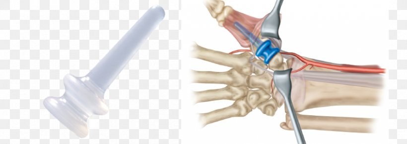 Finger Interphalangeal Joints Of The Hand Interphalangeal Joints Of The Hand Implant, PNG, 847x300px, Watercolor, Cartoon, Flower, Frame, Heart Download Free