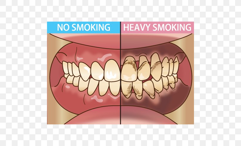 Tooth Dentist Periodontal Disease Tobacco Smoking 歯科, PNG, 500x500px, Tooth, Bad Breath, Dental Hygienist, Dentist, Eyelash Download Free