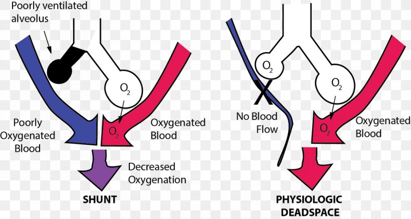 Pulmonary Shunt Ventilation/perfusion Ratio Dead Space, PNG, 1168x623px, Watercolor, Cartoon, Flower, Frame, Heart Download Free