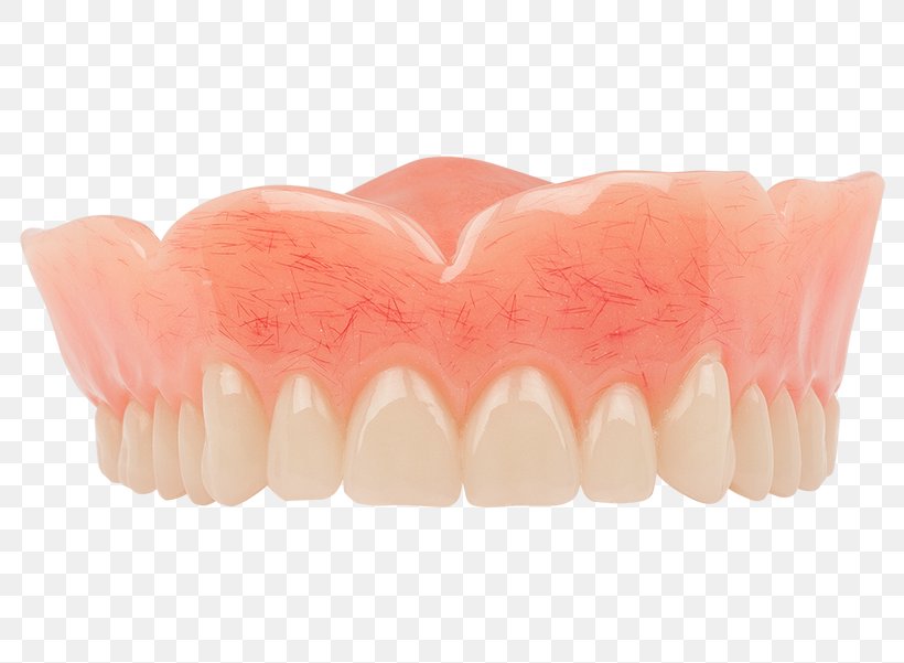 Tooth Dentures Dentistry Dental Implant, PNG, 800x601px, Tooth, Aspen Dental, Bridge, Cosmetic Dentistry, Dental Implant Download Free