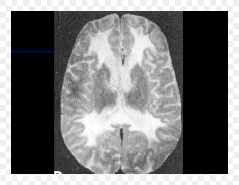 Computed Tomography Lääketieteellinen Röntgenkuvaus X-ray Brain Radiography, PNG, 1584x1224px, Watercolor, Cartoon, Flower, Frame, Heart Download Free