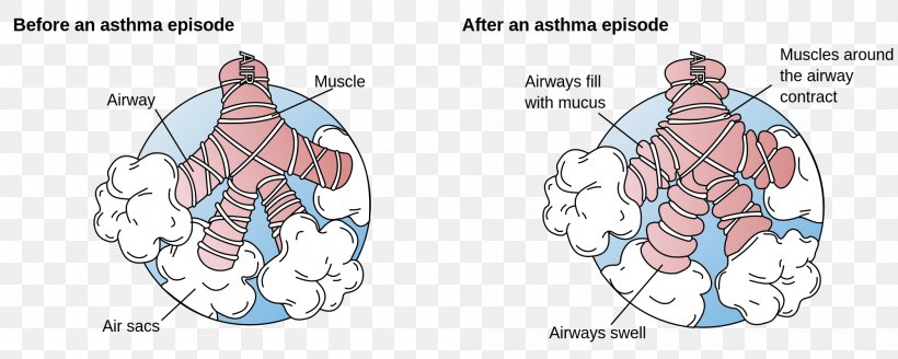 Asthma Bronchus Dyspnea Bronchospasm Disease, PNG, 2000x800px, Watercolor, Cartoon, Flower, Frame, Heart Download Free