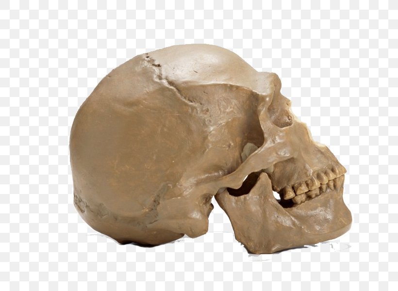 Skull Skeleton Bone, PNG, 801x600px, Skull, Bone, Dental Braces, Dental Extraction, Head Download Free