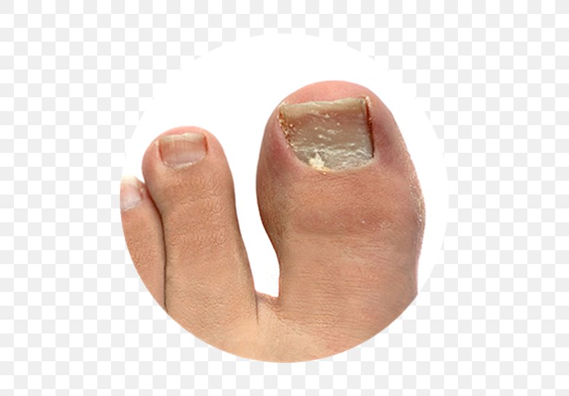 Onychomycosis Athlete's Foot Toe Nail Onychocryptosis, PNG, 570x570px, Onychomycosis, Ankle, Finger, Foot, Fungus Download Free