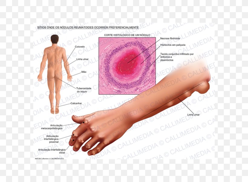 Rheumatoid Arthritis Rheumatoid Nodule Rheumatism, PNG, 600x600px, Rheumatoid Arthritis, Arm, Arthritis, Autoimmune Disease, Autoimmunity Download Free