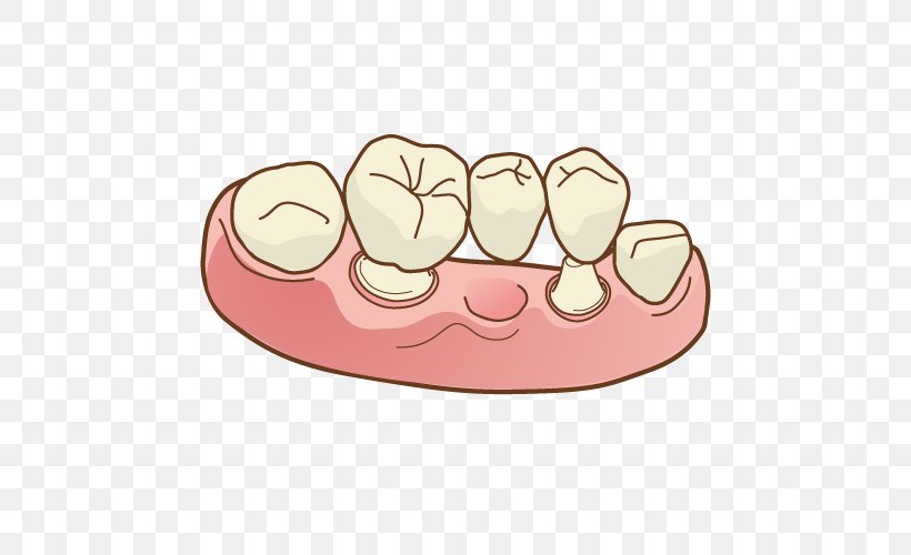 Dentist Dentures Therapy Dental Surgery 矯正歯科, PNG, 500x500px, Dentist, Bridge, Dental Implant, Dental Surgery, Dentures Download Free
