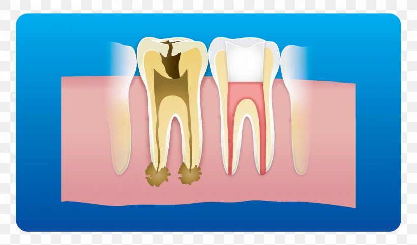 Tooth Dental Implant Root Canal Dentistry Pulp, PNG, 1421x835px, Watercolor, Cartoon, Flower, Frame, Heart Download Free