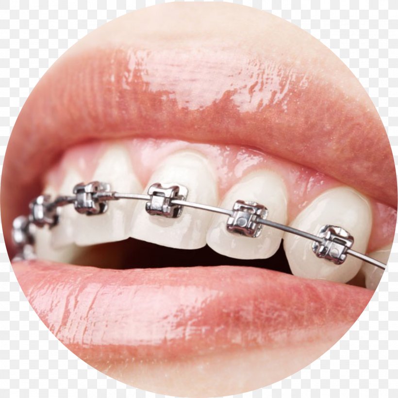 Orthodontics Dental Braces Dentistry Damon System, PNG, 1345x1344px, Orthodontics, Clear Aligners, Cosmetic Dentistry, Damon System, Dental Braces Download Free