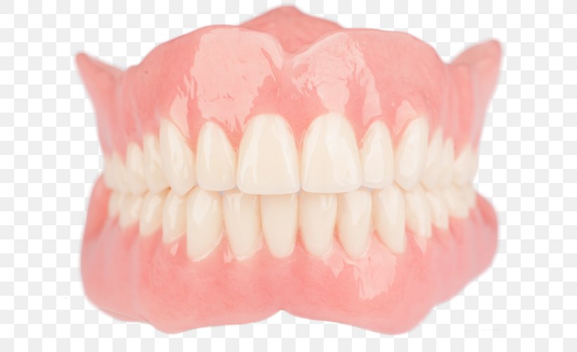 Tooth Dentures Dentistry Dental Laboratory, PNG, 662x500px, Tooth, Bridge, Crown, Dental Implant, Dental Laboratory Download Free