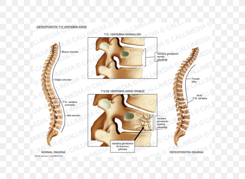 Vertebral Column Bone Fracture Vertebral Compression Fracture Anatomy Png 600x600px Watercolor Cartoon Flower Frame Heart Download