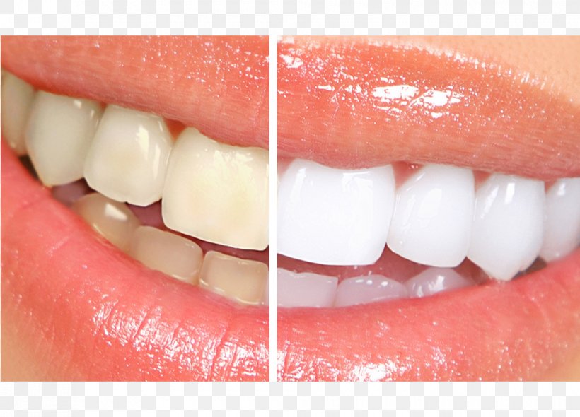 Cosmetic Dentistry Tooth Whitening, PNG, 980x706px, Dentistry, Clear Aligners, Cosmetic Dentistry, Dental Implant, Dentist Download Free