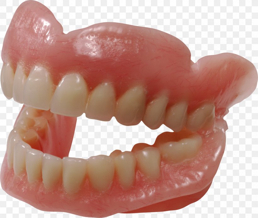 Dentures Dentistry Human Tooth Removable Partial Denture, PNG, 1662x1408px, Human Tooth, Dentist, Dentistry, Dentures, Gums Download Free
