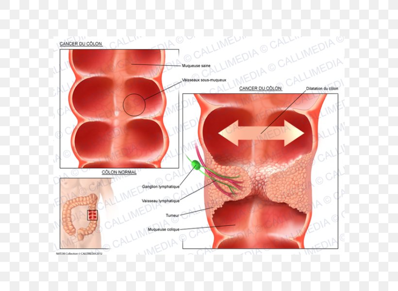 Illustration Anatomique Ductal Carcinoma In Situ Oncology, PNG, 600x600px, Watercolor, Cartoon, Flower, Frame, Heart Download Free