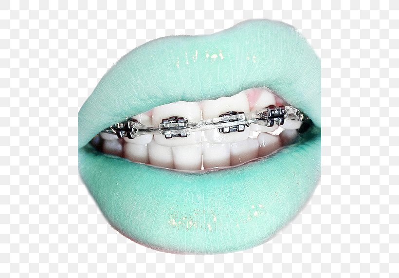 Dental Braces Clear Aligners Lip Retainer Tooth, PNG, 500x571px, Dental Braces, Aqua, Child, Clear Aligners, Color Download Free