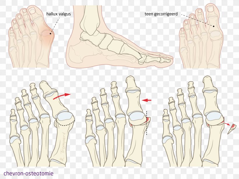 Thumb Hallux Foot Bunion Toe, PNG, 1020x768px, Watercolor, Cartoon, Flower, Frame, Heart Download Free