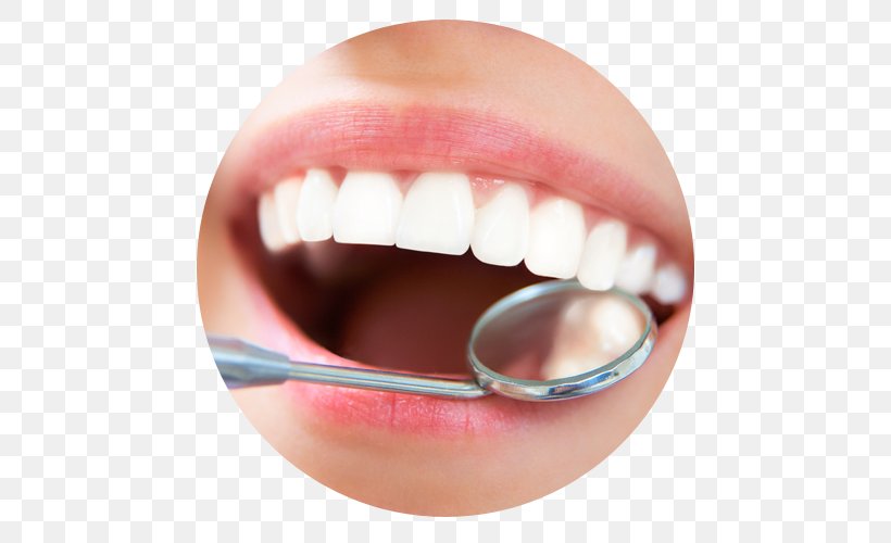 Dentistry Scaling And Root Planing Dental Implant Teeth Cleaning, PNG, 500x500px, Dentist, Cheek, Chin, Cosmetic Dentistry, Dental Implant Download Free