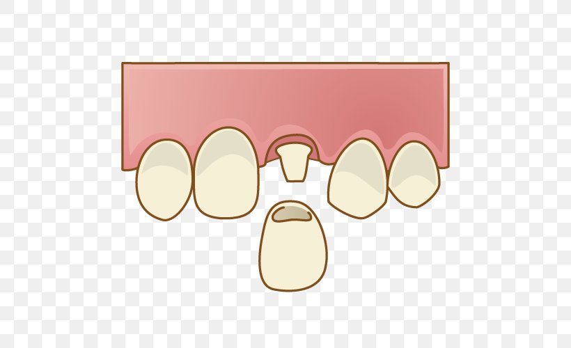 Sakayori Dental Clinic Dentistry 歯科 歯冠継続歯, PNG, 500x500px, Dentist, Dental Technician, Dentistry, Dentures, Eyewear Download Free