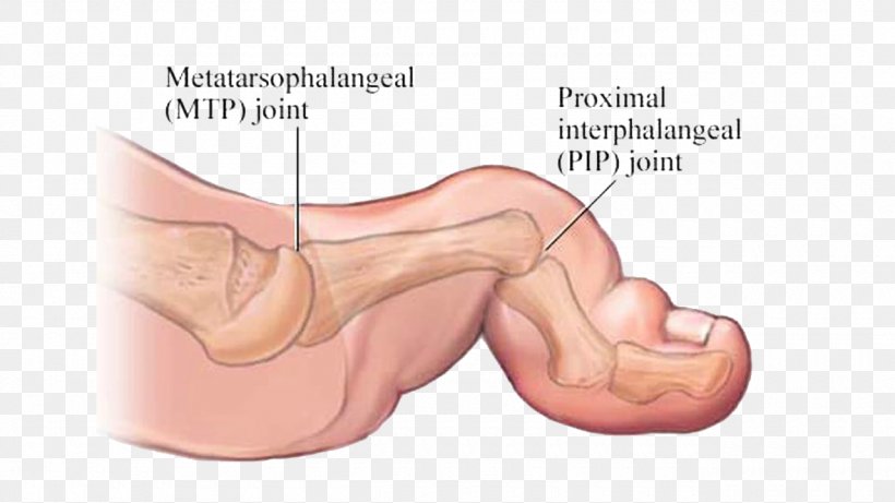 Bent Finger Foot Ankle Human Body Pain, PNG, 1280x720px, Watercolor, Cartoon, Flower, Frame, Heart Download Free