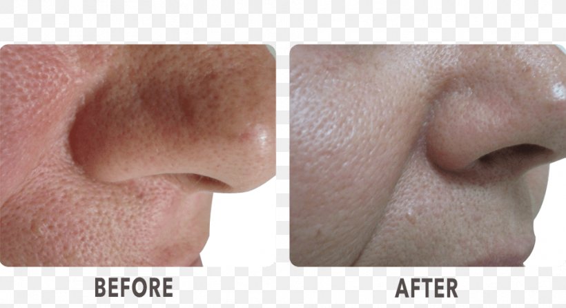 La Skinnovita- Dr. Anuj Pall Dermatology, Laser & Hair Centre Nose Cheek Chin Collagen Induction Therapy, PNG, 963x524px, Nose, Cheek, Chin, Close Up, Collagen Induction Therapy Download Free