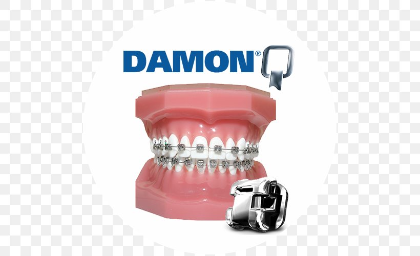 Damon System Dental Braces Orthodontics Self-ligating Bracket Dentistry, PNG, 500x500px, Damon System, Clear Aligners, Dental Braces, Dental Implant, Dentistry Download Free