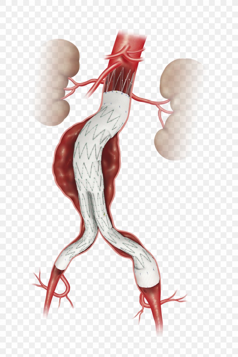 Abdominal Aortic Aneurysm Endovascular Aneurysm Repair Aorta, PNG, 1312x1969px, Watercolor, Cartoon, Flower, Frame, Heart Download Free