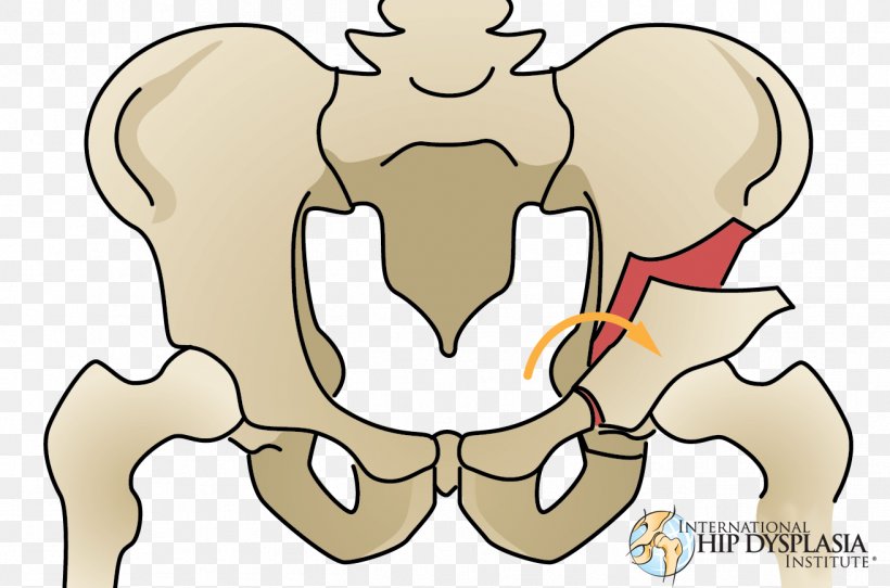 Osteotomy Hip Dysplasia Acetabulum Femur, PNG, 1313x869px, Watercolor, Cartoon, Flower, Frame, Heart Download Free