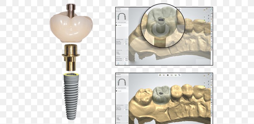 Dental Implant Temporary Crown Screw, PNG, 675x401px, Dental Implant, Bone, Brass, Cadcam Dentistry, Cement Download Free