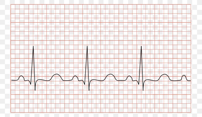 Electrocardiography Sinus Tachycardia Heart Rate, PNG, 800x474px, Watercolor, Cartoon, Flower, Frame, Heart Download Free